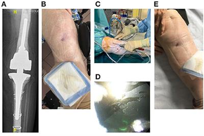 Arthroscopic “Debridement and Implant Retention” With Local Administration of Exebacase (Lysin CF-301) Followed by Suppressive Tedizolid as Salvage Therapy in Elderly Patients for Relapsing Multidrug-Resistant S. epidermidis Prosthetic Knee Infection